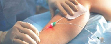 Endovenous Laser Ablation Therapy